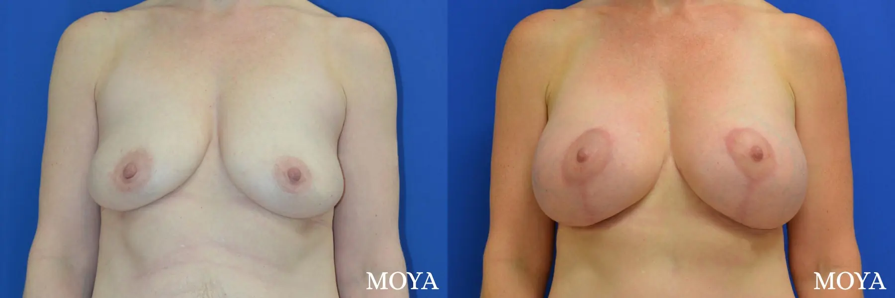 Breast Augmentation With Lift: Patient 11 - Before and After 1