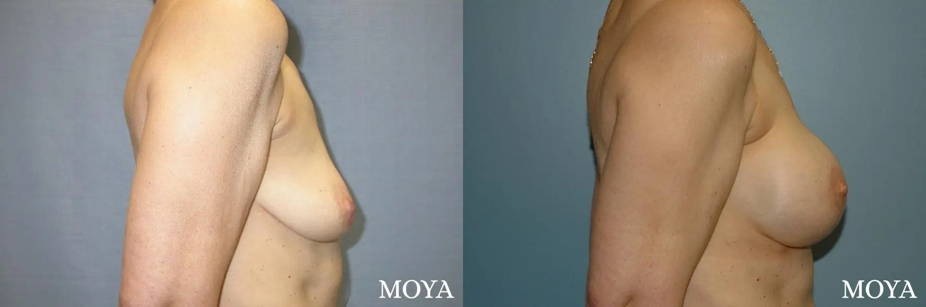 Breast Augmentation With Lift: Patient 3 - Before and After 2