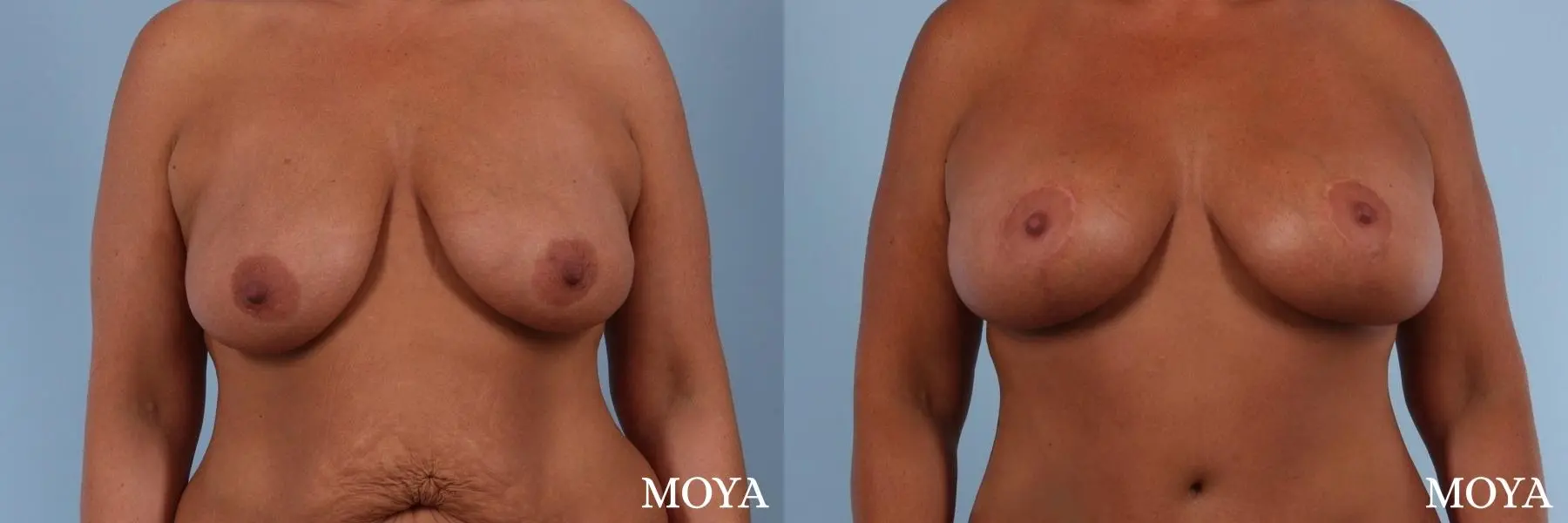 Breast Augmentation With Lift: Patient 8 - Before and After 1