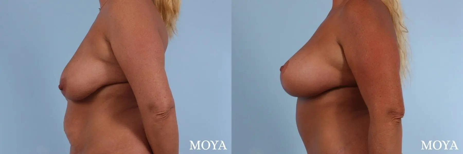 Breast Augmentation With Lift: Patient 8 - Before and After 2