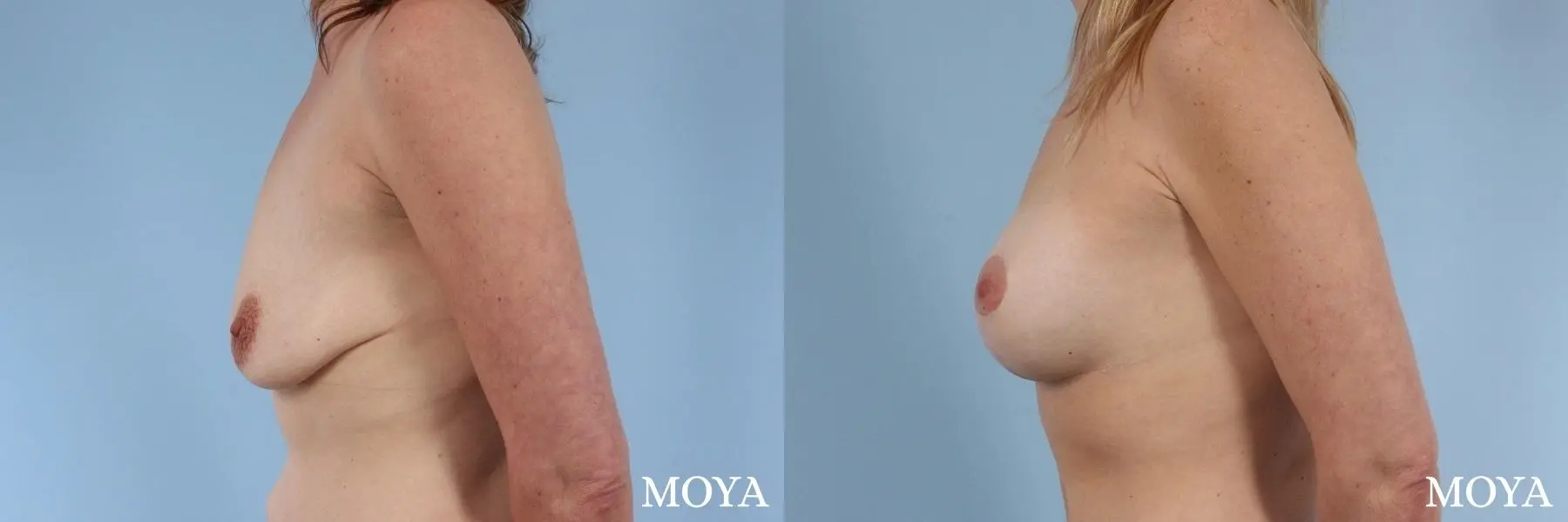 Breast Augmentation With Lift: Patient 12 - Before and After 2