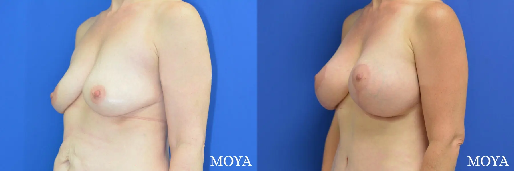 Breast Augmentation With Lift: Patient 11 - Before and After 2