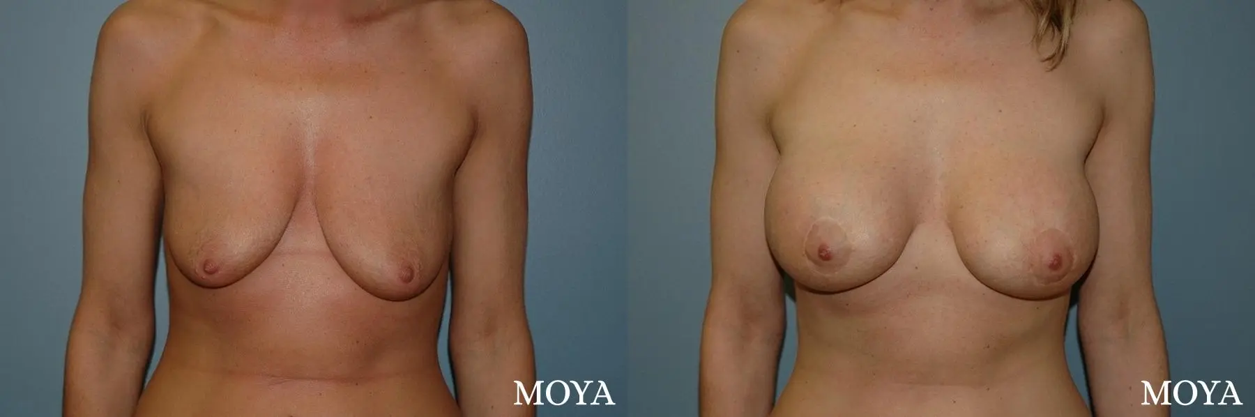 Breast Augmentation With Lift: Patient 2 - Before and After 1