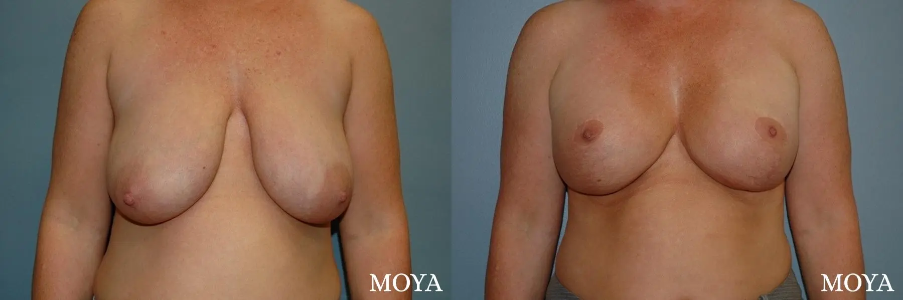 Breast Augmentation With Lift: Patient 9 - Before and After 1
