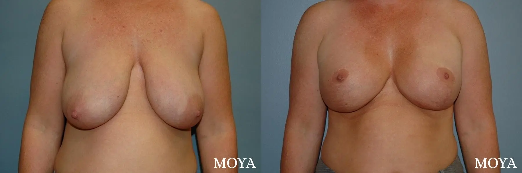 Breast Augmentation With Lift: Patient 9 - Before and After  