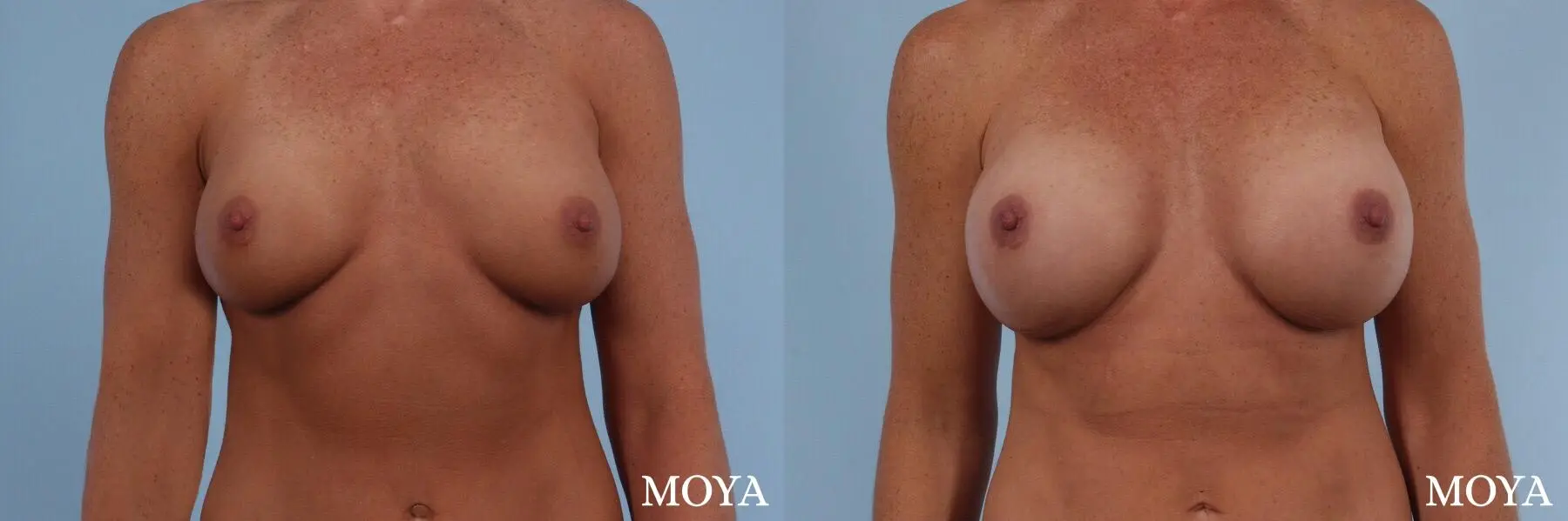 Breast Implant Exchange: Patient 3 - Before and After  