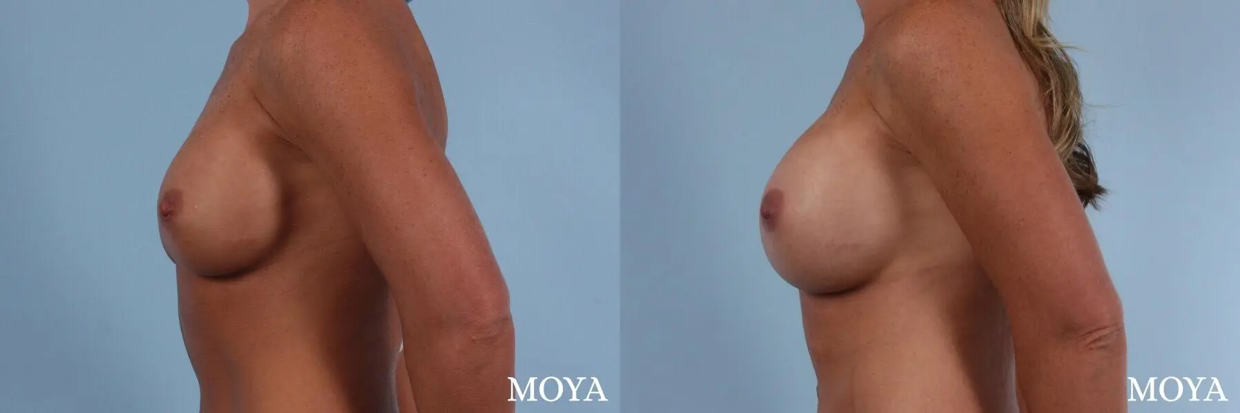 Breast Implant Exchange: Patient 3 - Before and After 2