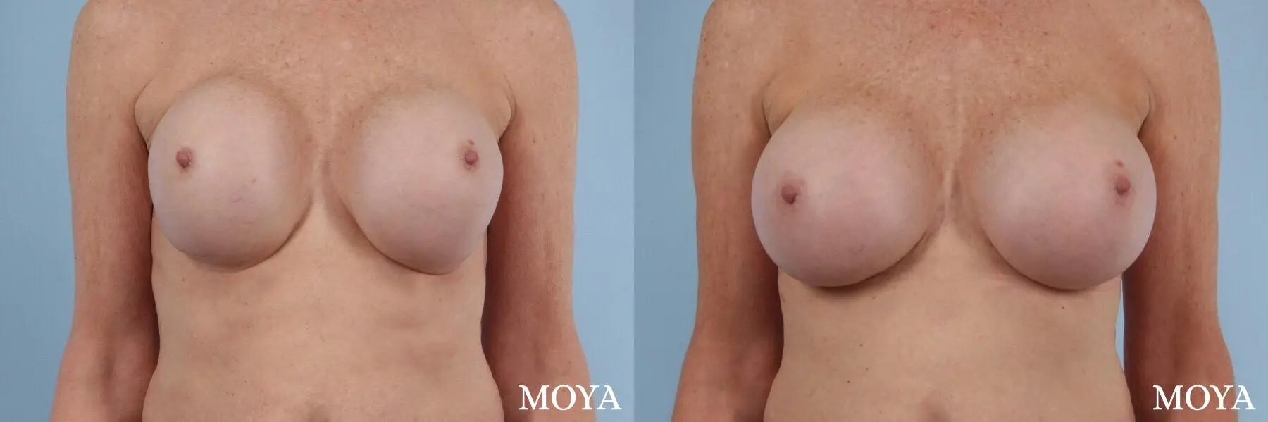 Breast Implant Exchange: Patient 6 - Before and After 1