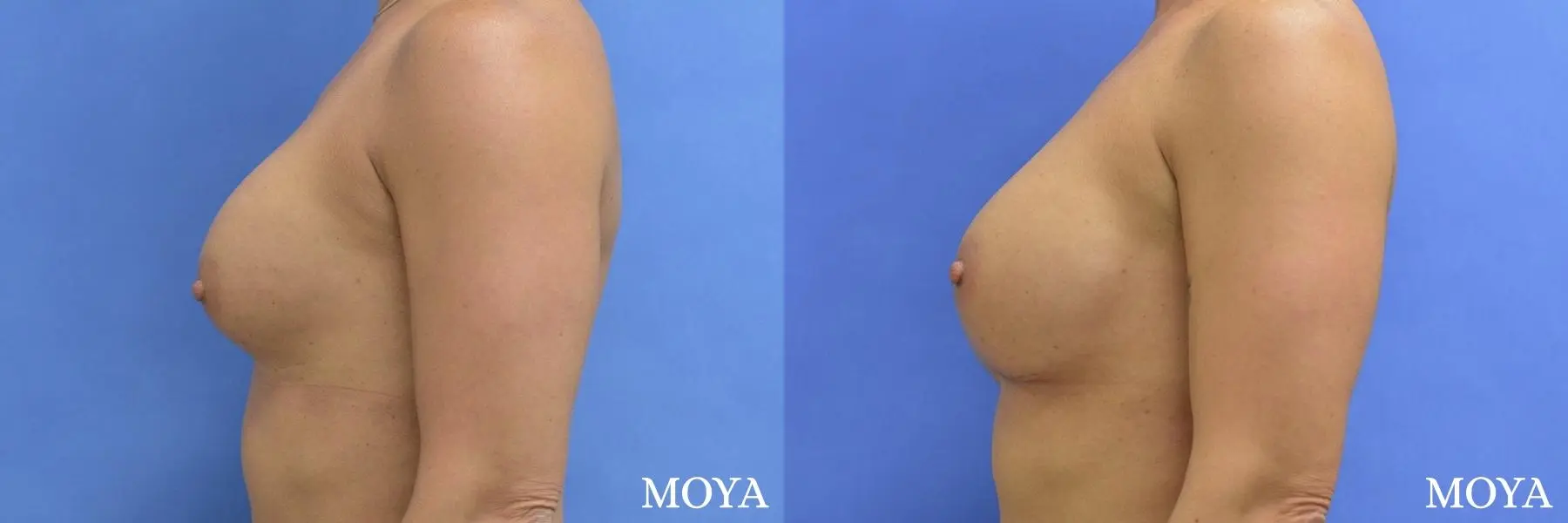 Breast Implant Exchange: Patient 4 - Before and After 6