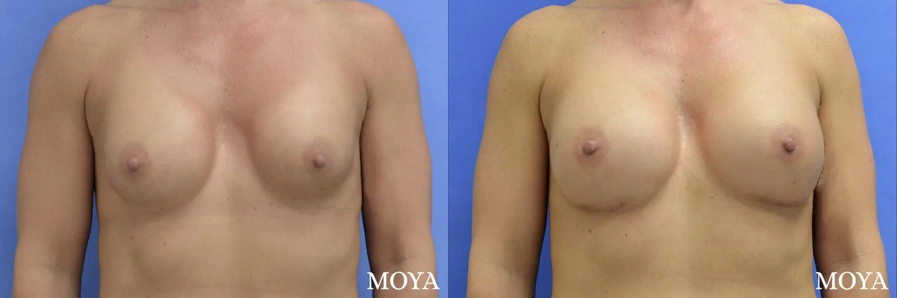 Breast Implant Exchange: Patient 4 - Before and After 5