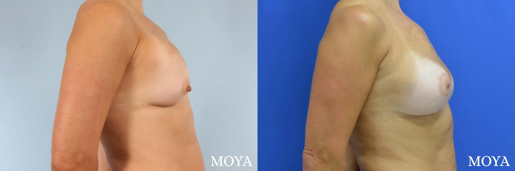 Breast Implant Exchange: Patient 5 - Before and After 2