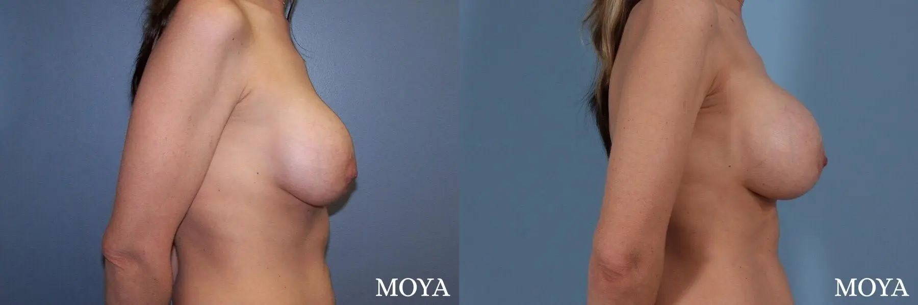 Breast Implant Exchange: Patient 2 - Before and After 2