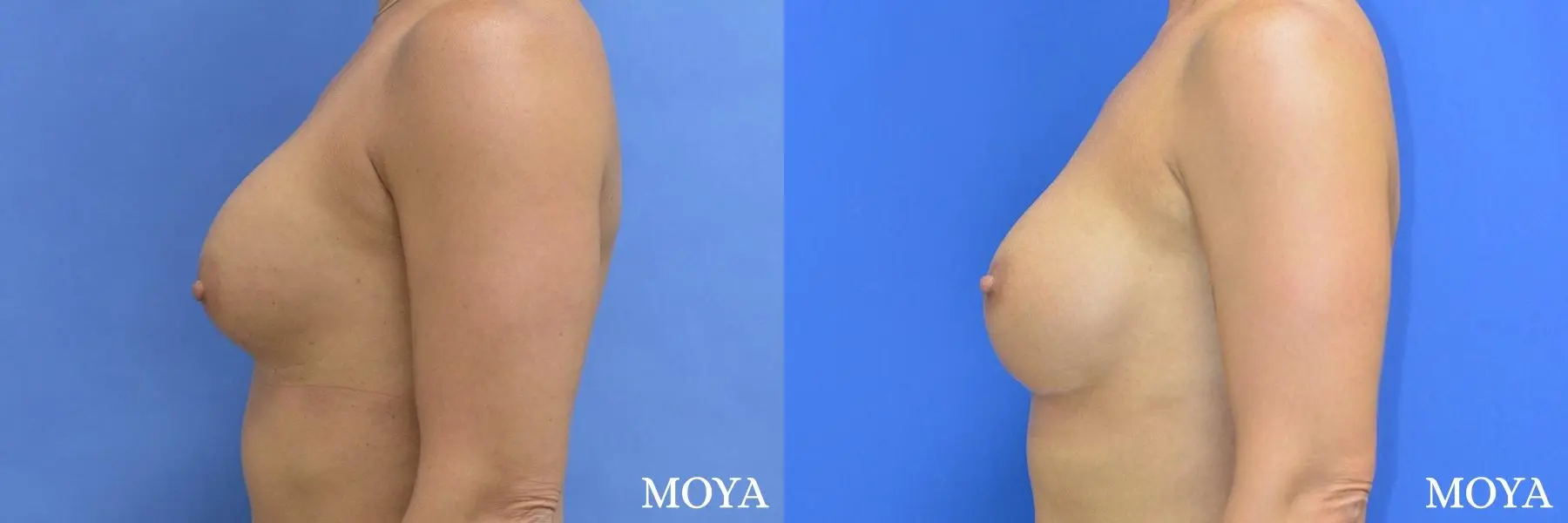 Breast Implant Exchange: Patient 4 - Before and After 2