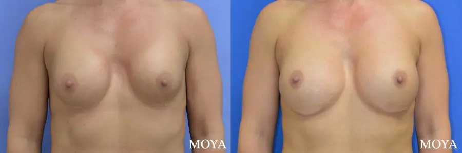 Breast Implant Exchange: Patient 4 - Before and After  
