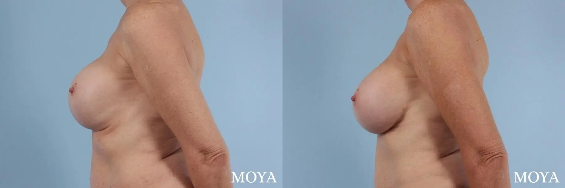 Breast Implant Exchange: Patient 6 - Before and After 2