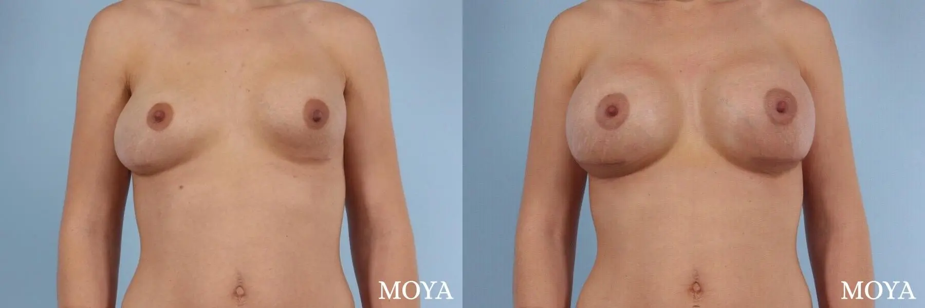 Breast Implant Exchange: Patient 1 - Before and After 1