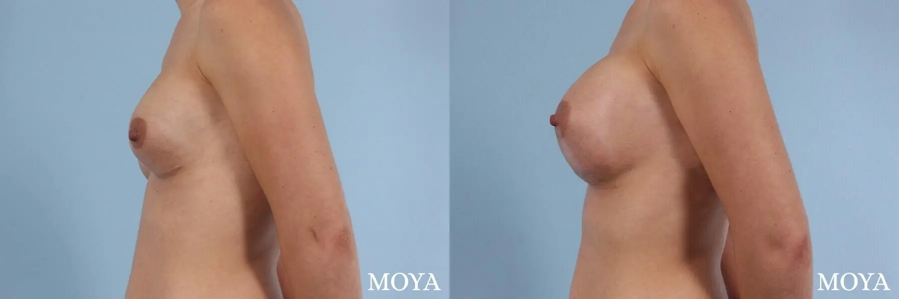 Breast Implant Exchange: Patient 1 - Before and After 2