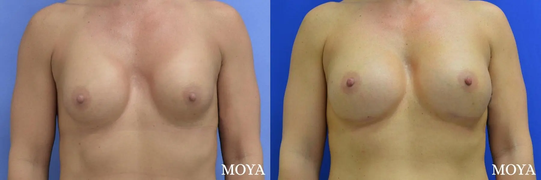 Breast Implant Exchange: Patient 4 - Before and After 3