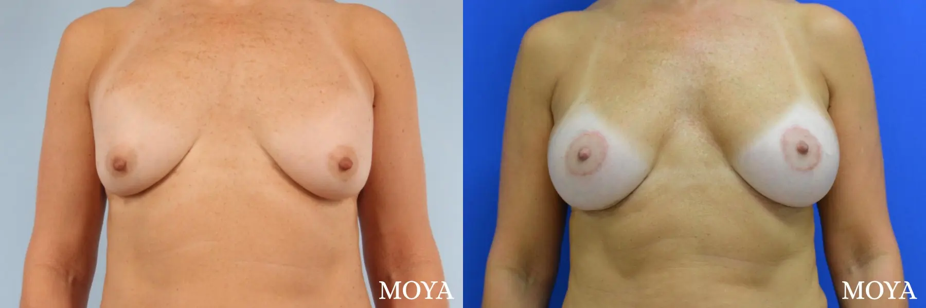 Breast Implant Exchange: Patient 5 - Before and After 1