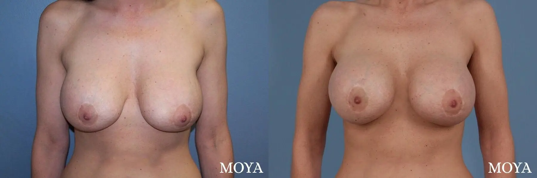 Breast Implant Exchange: Patient 2 - Before and After 1