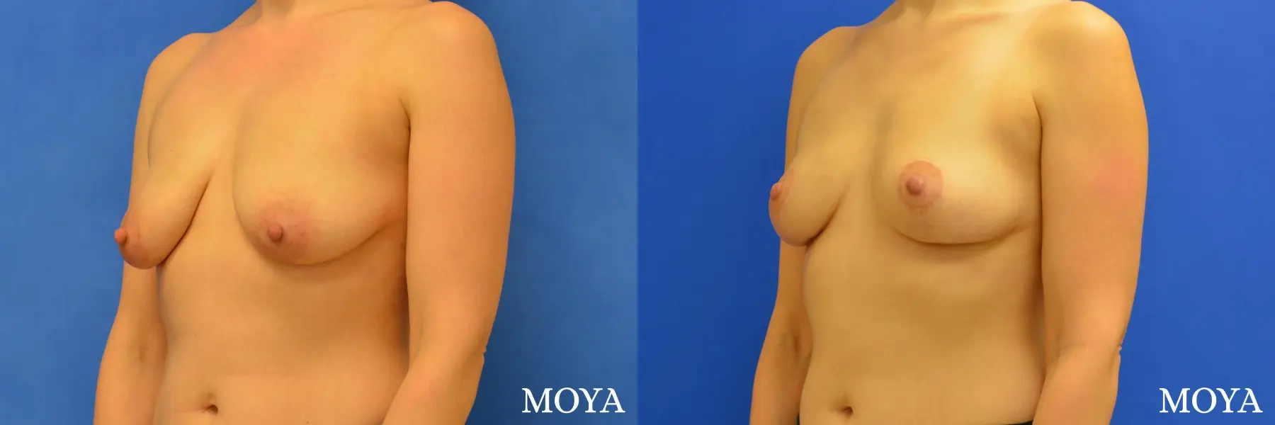 Breast Lift (anchor) - Before and After  