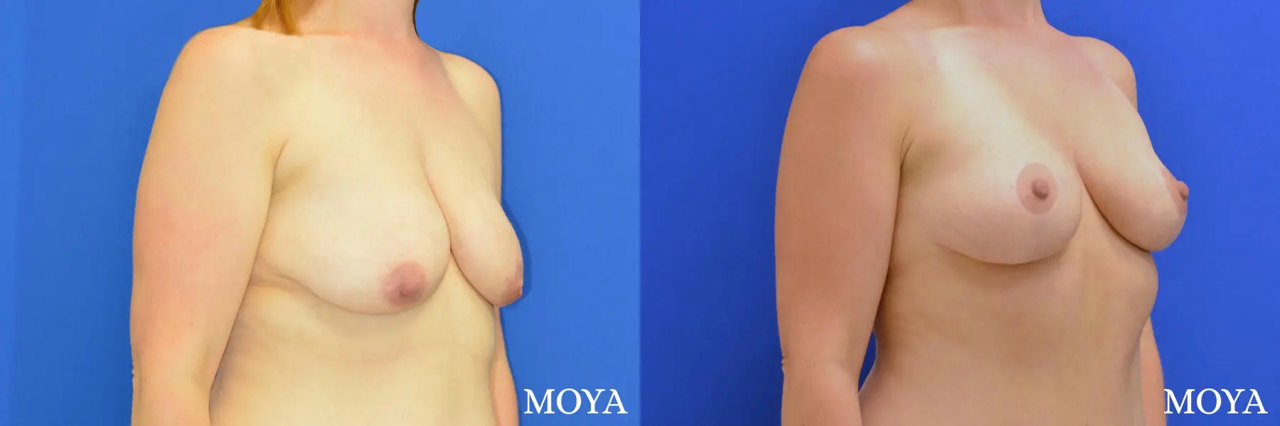 Breast Lift (anchor) - Before and After  