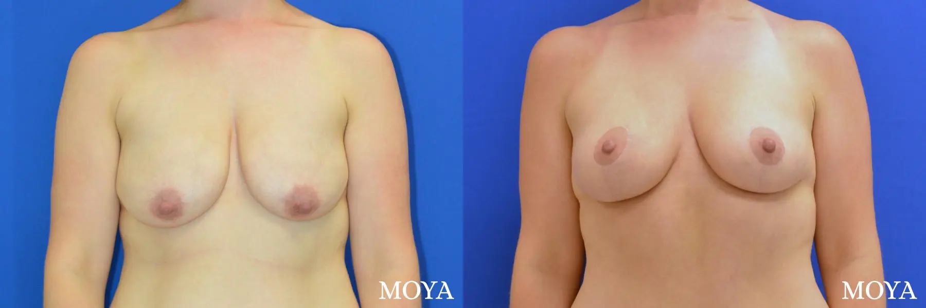 Breast Lift (anchor) - Before and After 2