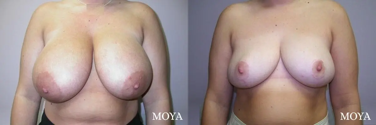 Breast Reduction: Patient 3 - Before and After 1
