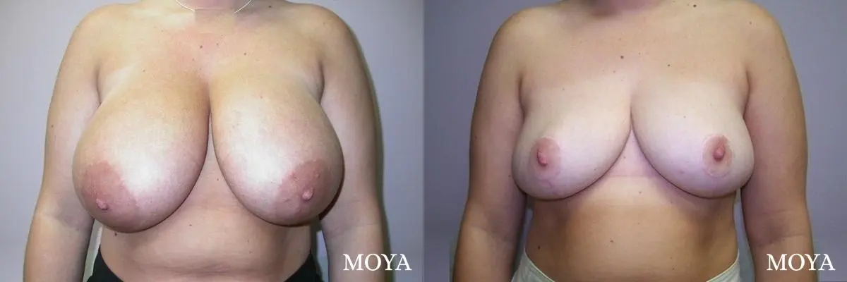 Breast Reduction: Patient 3 - Before and After  