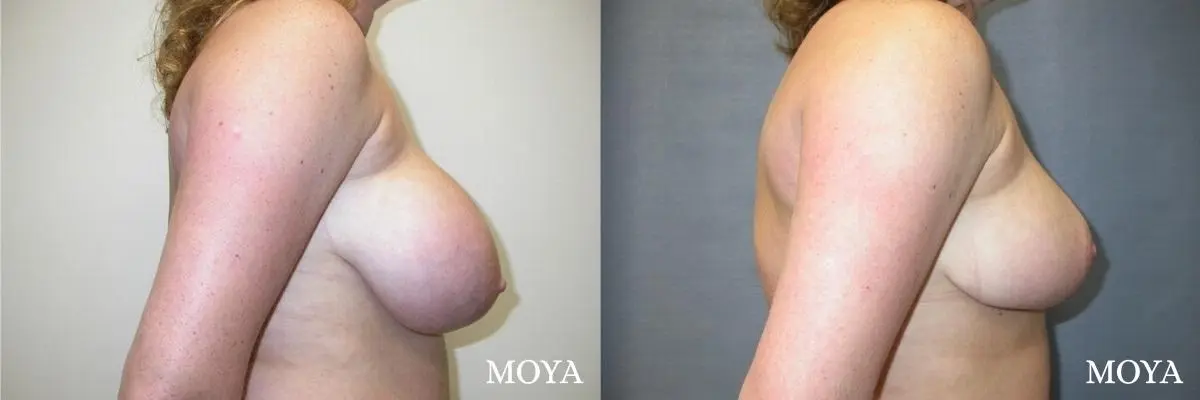 Breast Reduction: Patient 2 - Before and After 2