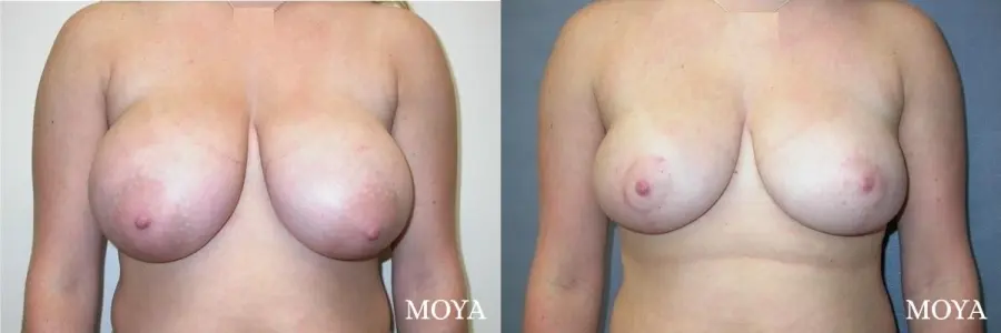 Breast Reduction: Patient 2 - Before and After  