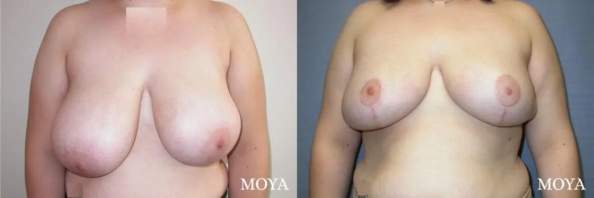 Breast Reduction: Patient 4 - Before and After  