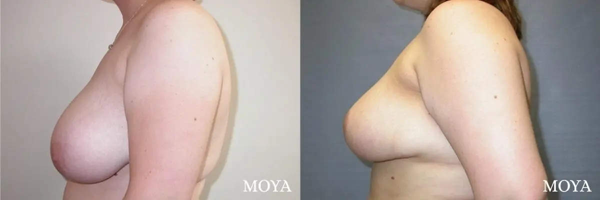 Breast Reduction: Patient 4 - Before and After 2