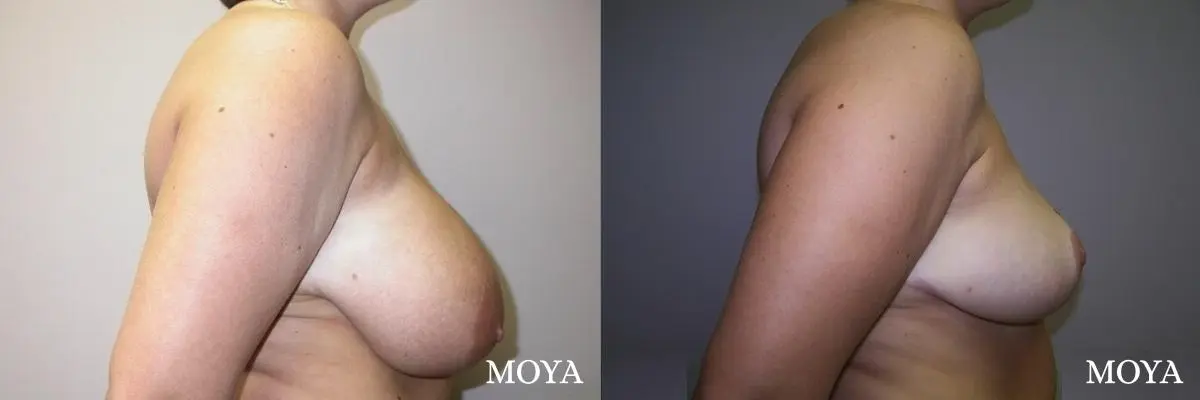 Breast Reduction: Patient 3 - Before and After 2