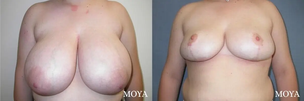 Breast Reduction: Patient 5 - Before and After  
