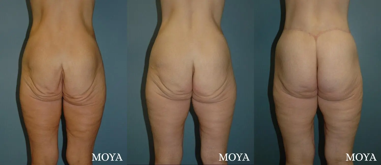 Butt Lift: Patient 1 - Before and After  