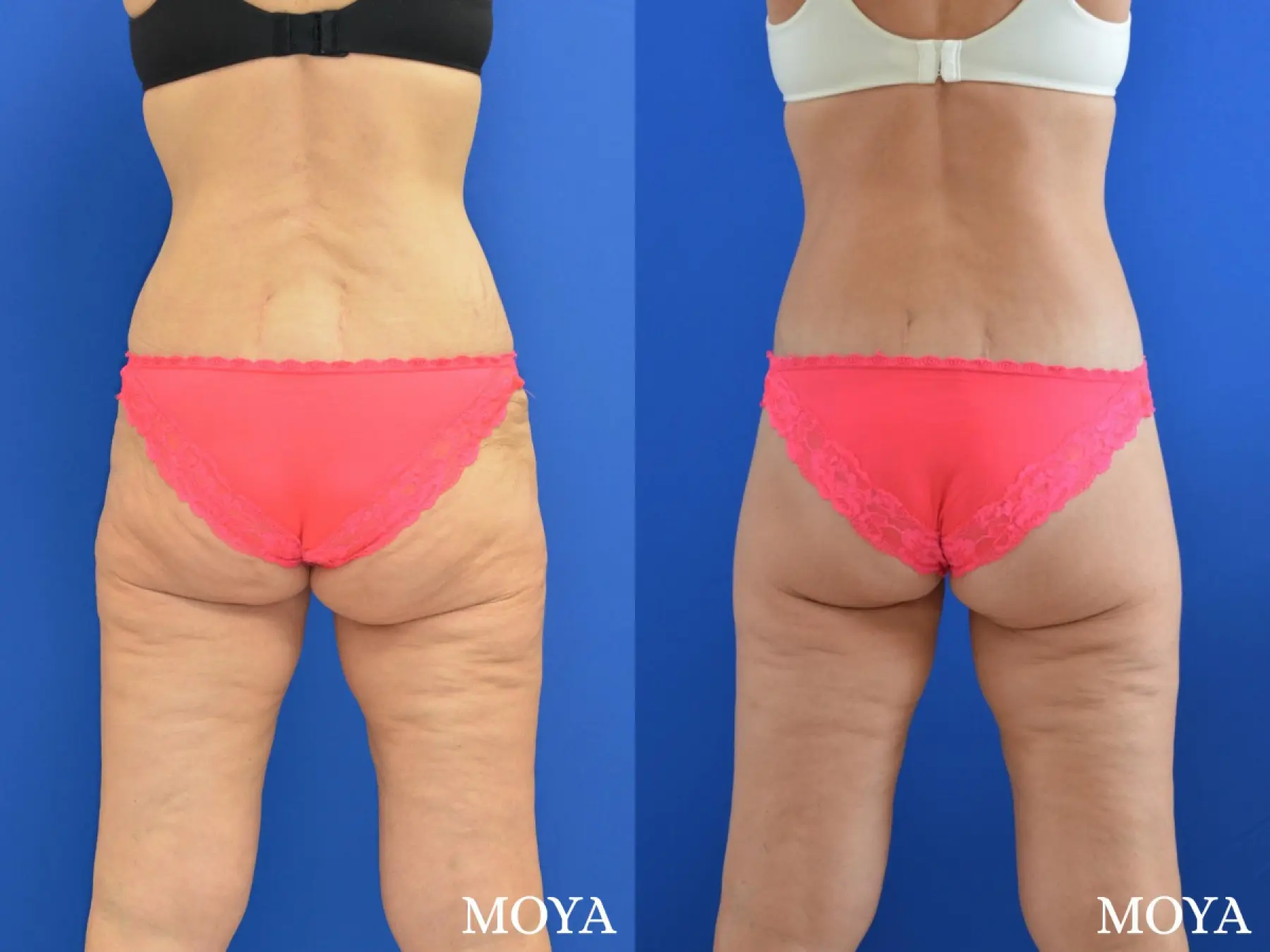 Butt Lift: Patient 2 - Before and After 1