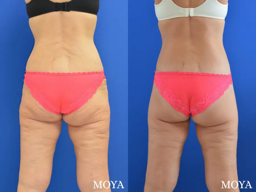 Butt Lift: Patient 2 - Before and After  