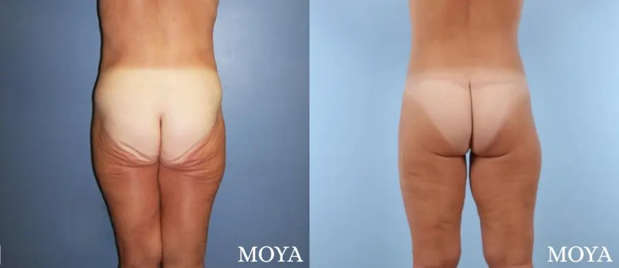 Butt Lift: Patient 3 - Before and After  