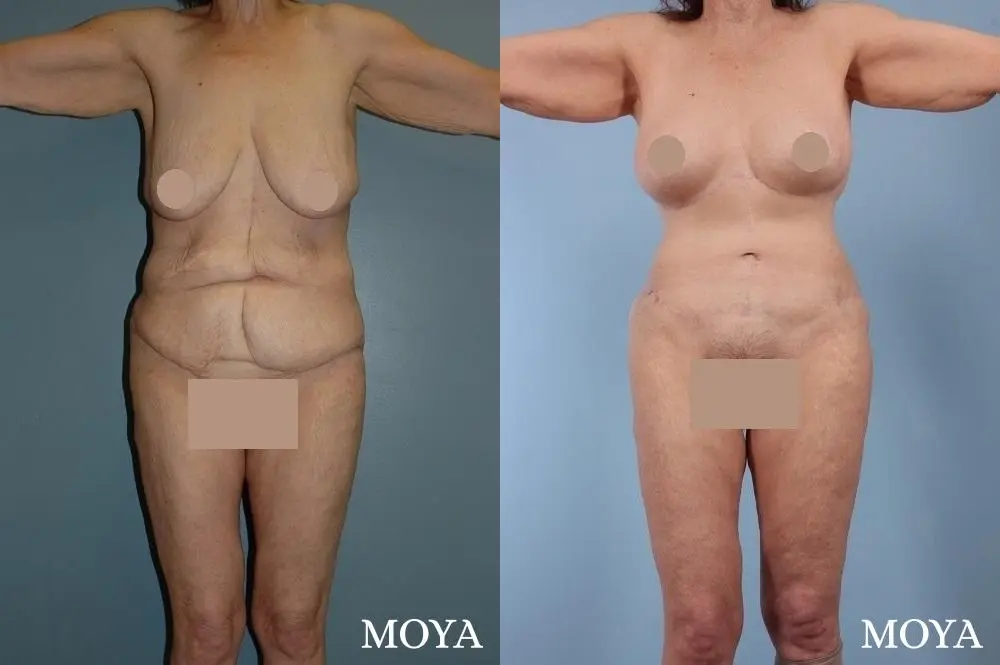 Corset Body Lift® (standard): BMI 24 - Before and After 1