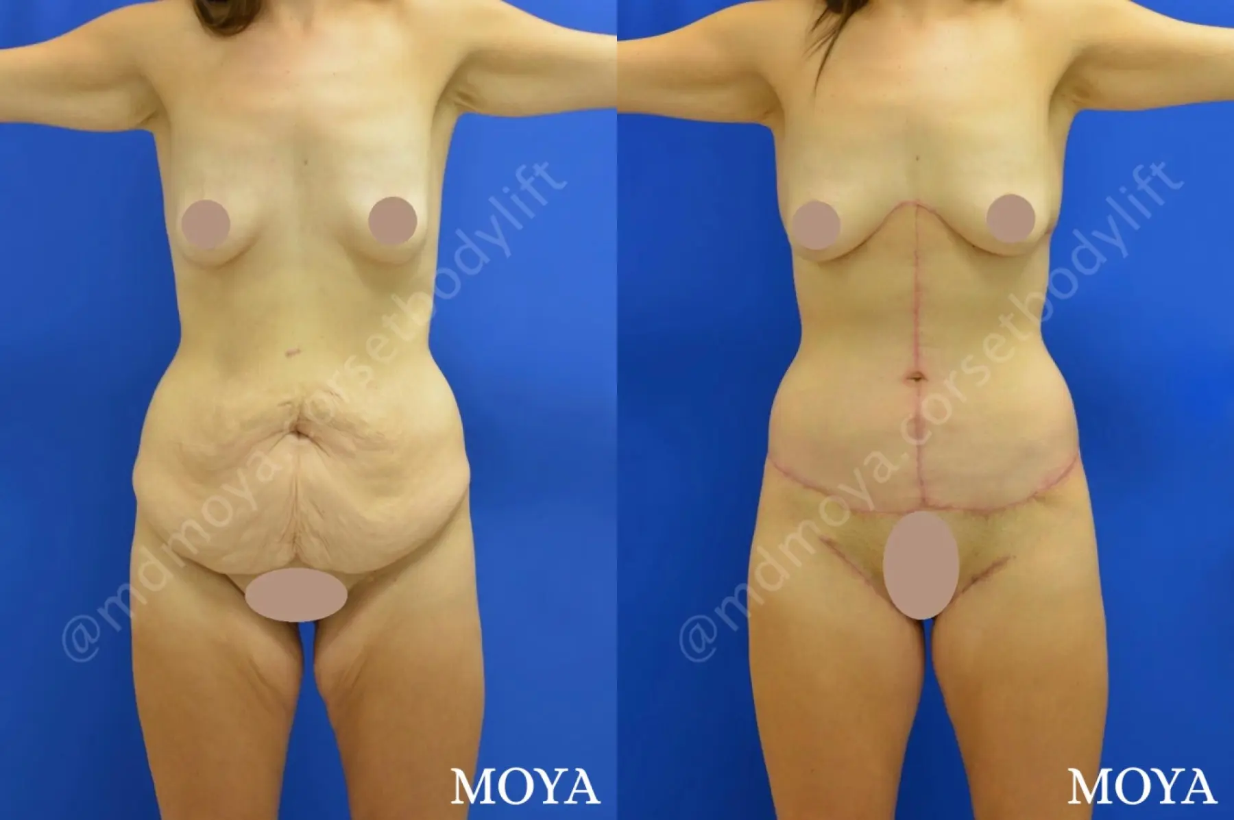 Corset Body Lift® (std):  BMI 23 - Before and After  