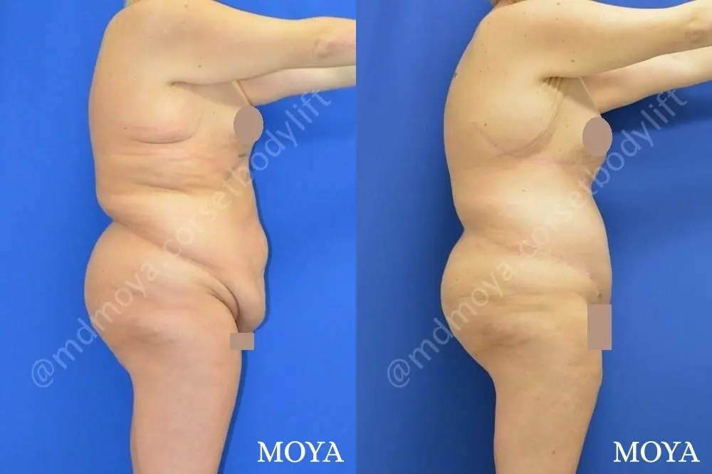 Corset Body Lift® (std): BMI 32 | Age 28 - Before and After 2