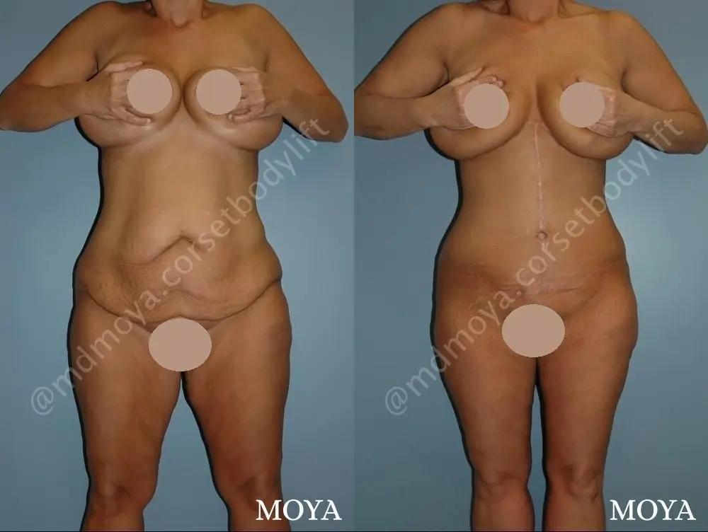 Corset Body Lift® (standard): BMI 27 | Age 38 - Before and After 1