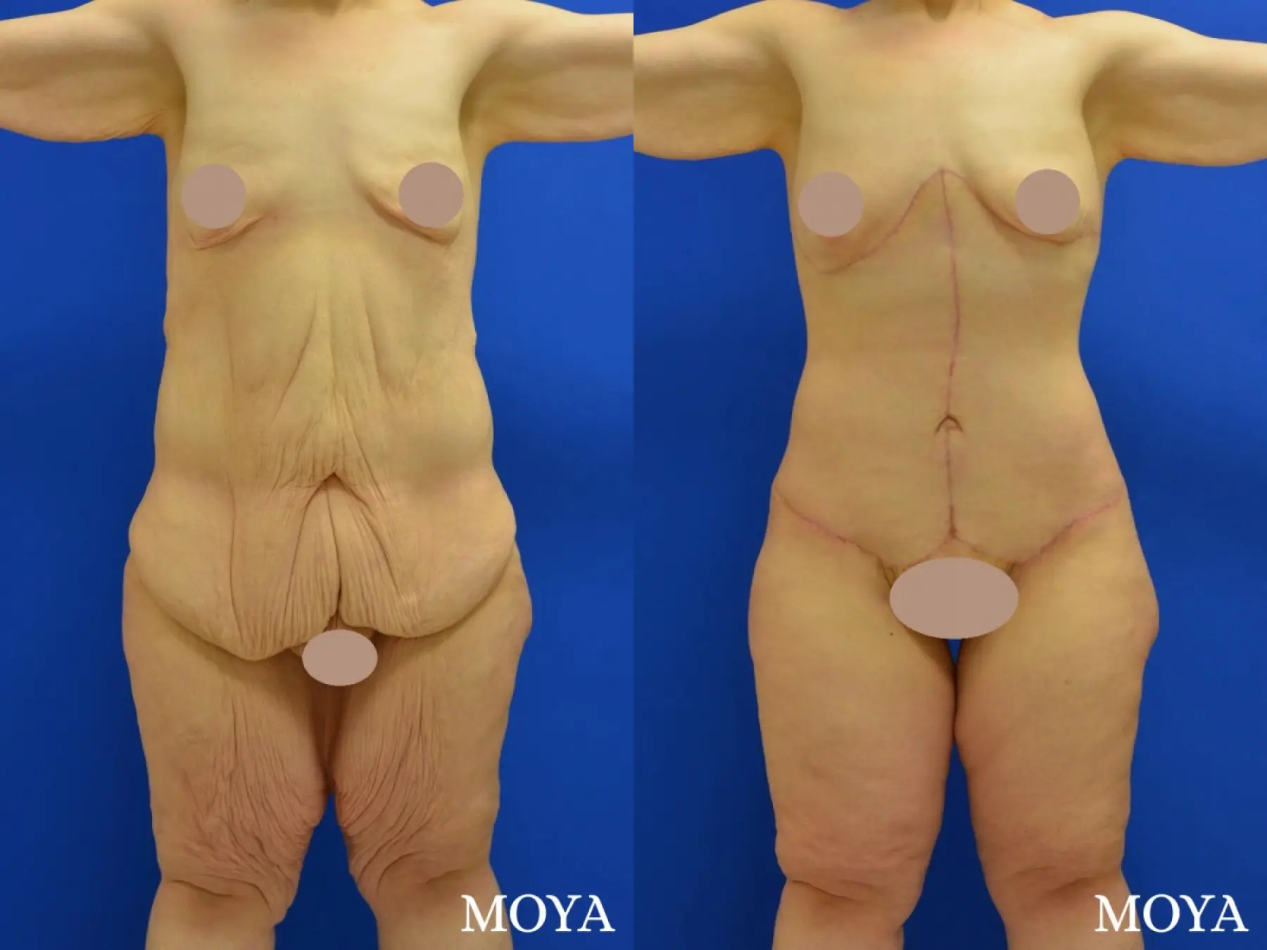 Corset Body Lift® (standard): BMI 33 - Before and After 4