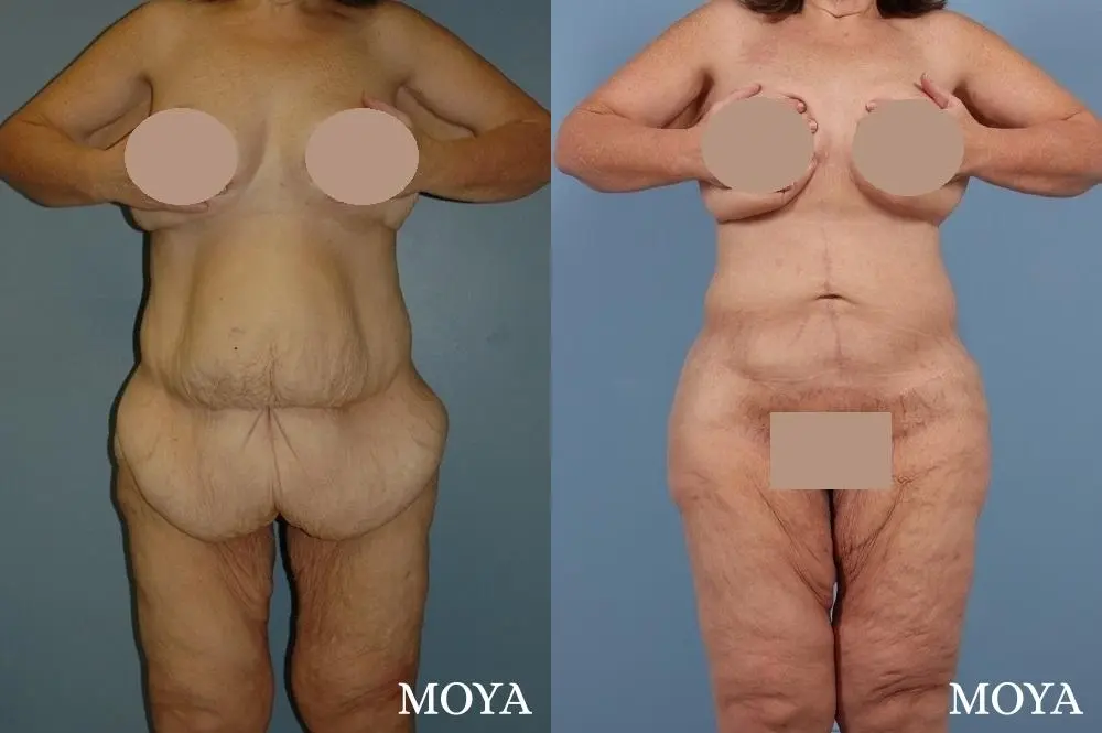 Corset Body Lift® (standard): BMI 33 - Before and After 1