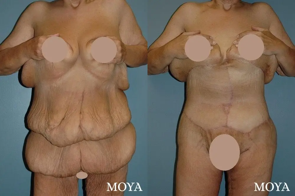 Corset Body Lift® (standard): BMI 27 - Before and After 1