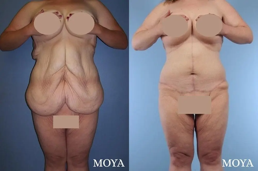 Corset Body Lift® (standard): BMI 34 - Before and After 1