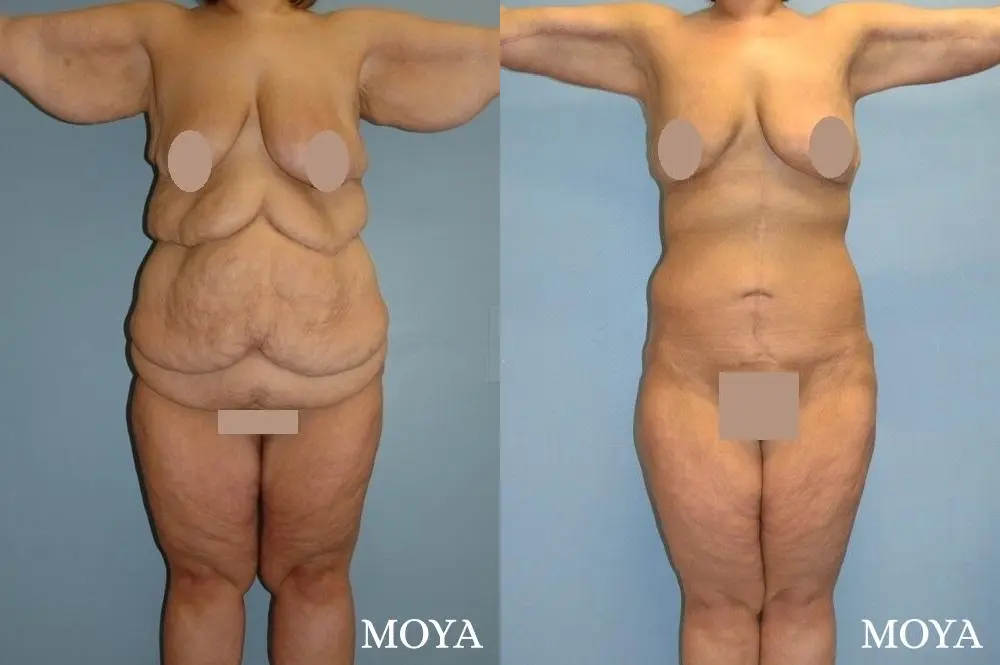 Corset Body Lift® (standard): BMI 37 - Before and After 1