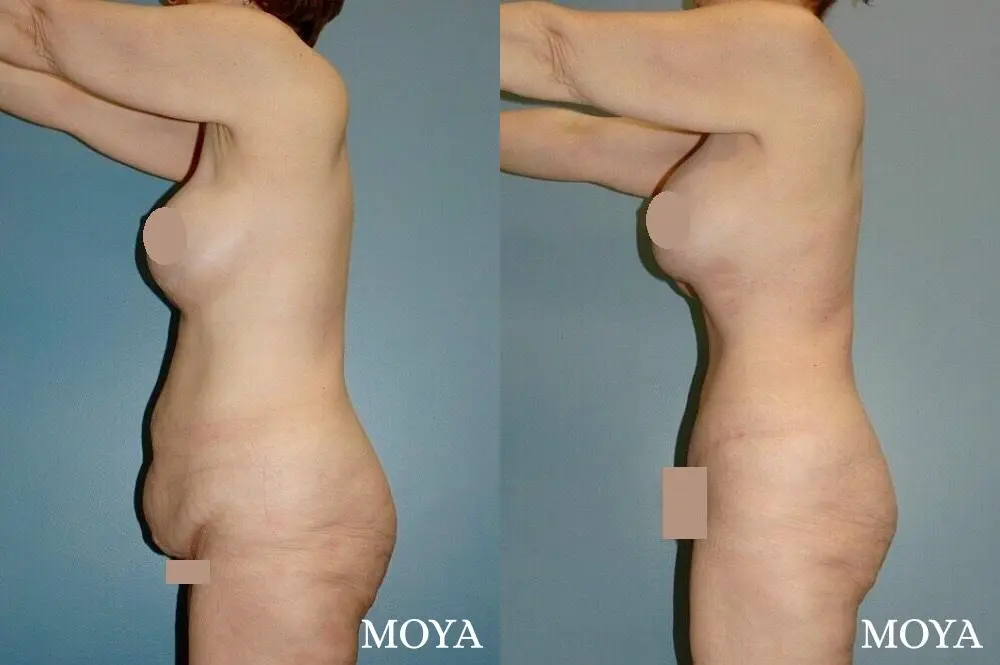 Corset Body Lift® (standard): BMI 27 - Before and After 2