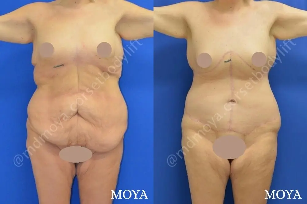 Corset Body Lift® (std): BMI 32 | Age 28 - Before and After 1
